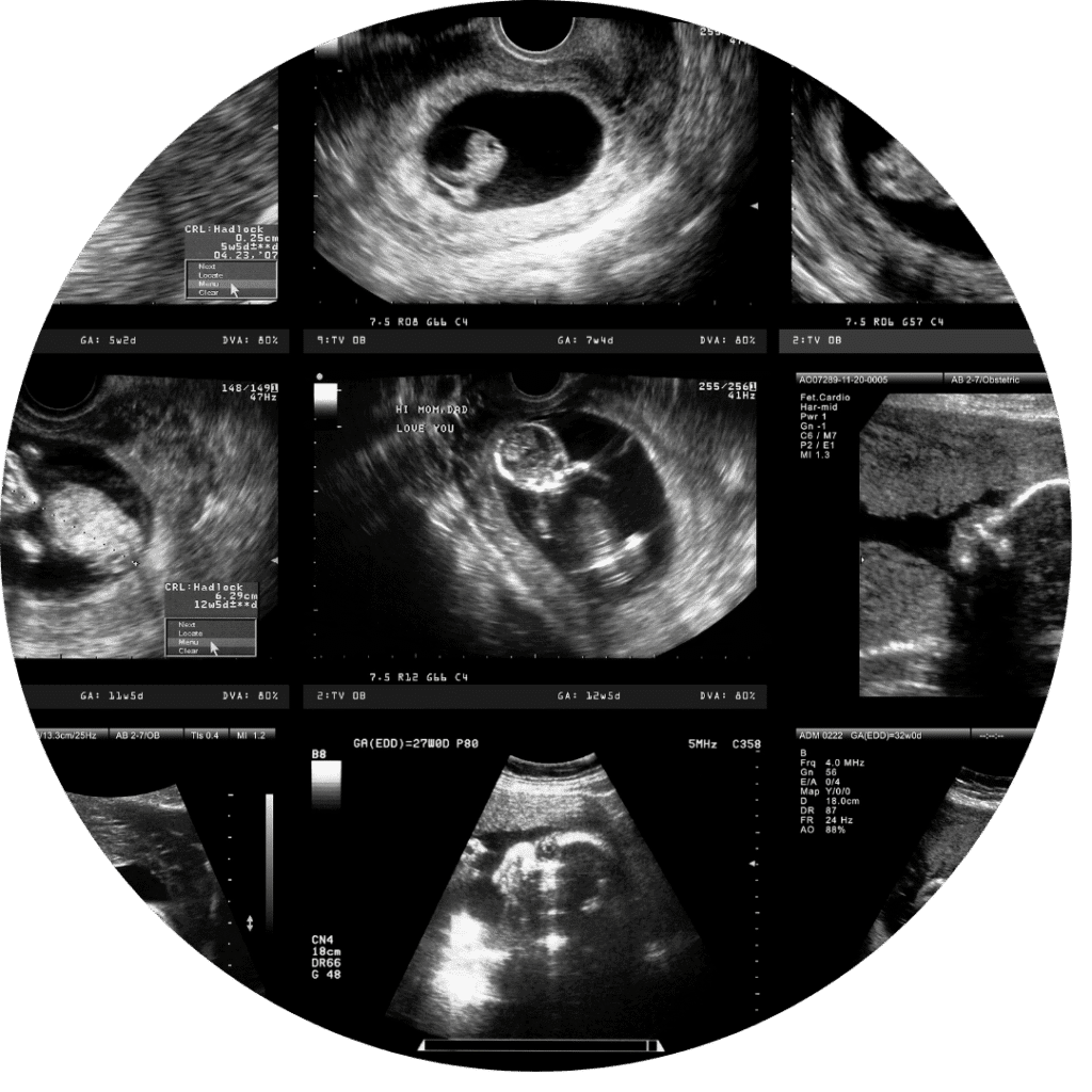 Baby Tyme Kyalami - Early Pregnancy Ultrasound Scan